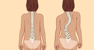 Scoliosis is the cause of lumbar tumors