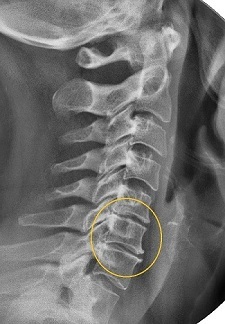Narrow disc space on radiographs