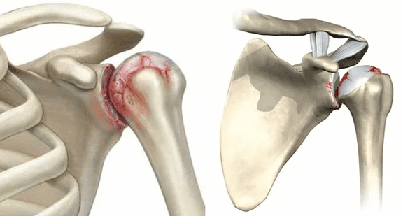 What does osteoarthritis of the shoulder look like 