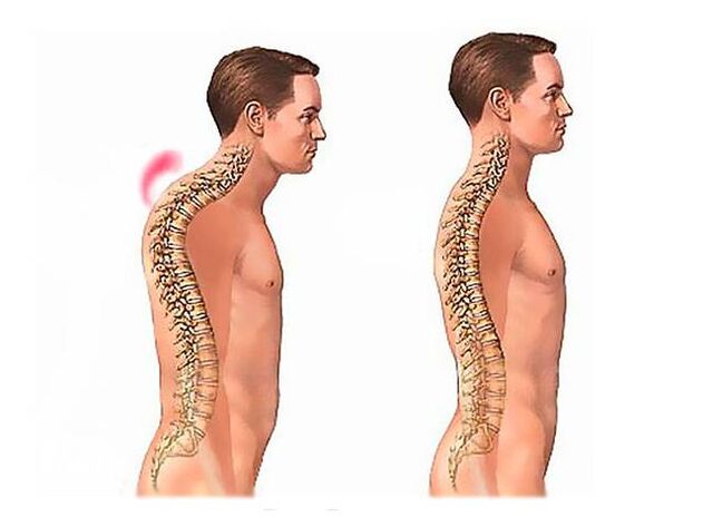 Kyphosis of the spine