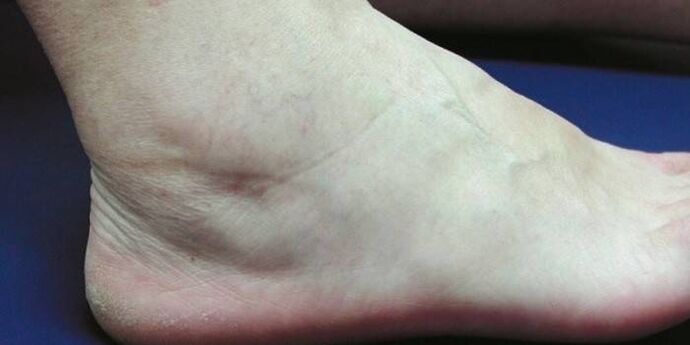 ankle swelling with arthritis viêm