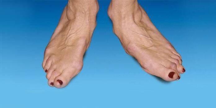 deformity of the foot with ankylosing spondylitis