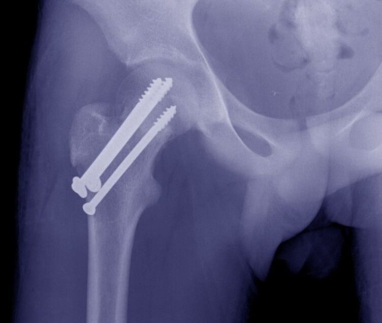 X-ray hip joint, bone fracture with fixed instruments inside. 