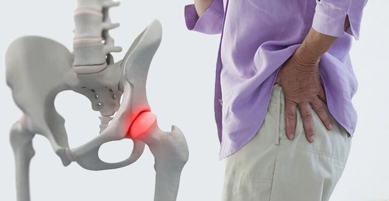 pain in the hip area - a symptom of hip arthritis