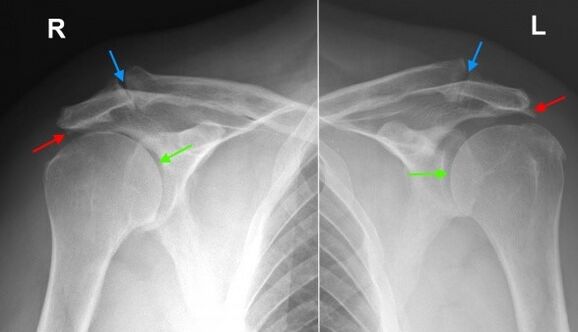 X-ray of shoulder joint