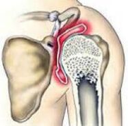 shoulder joint disease