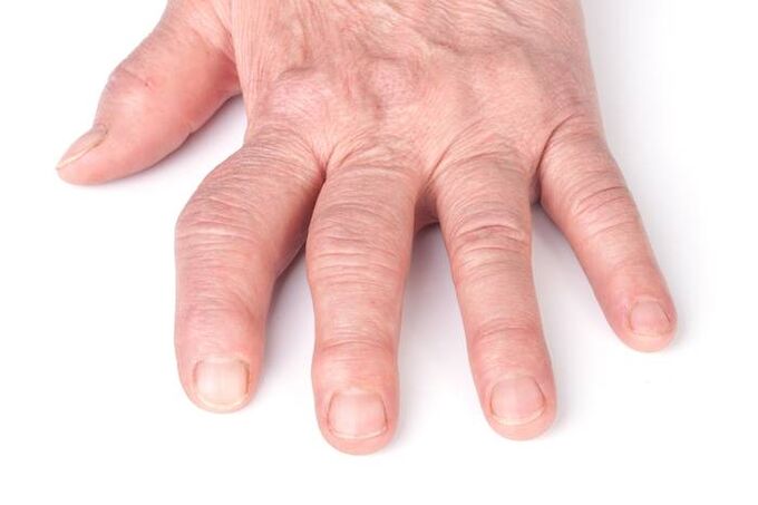 hand joint deformity