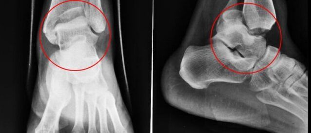X-ray for ankle joint disease