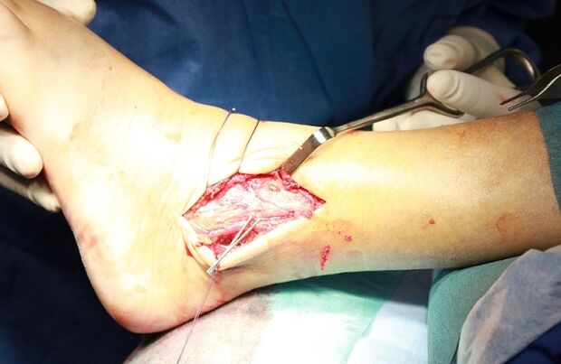 ankle joint surgery