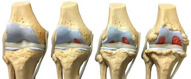 joint damage at different developmental stages of ankle arthritis