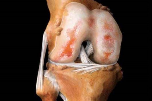 knee joint damage with paresis