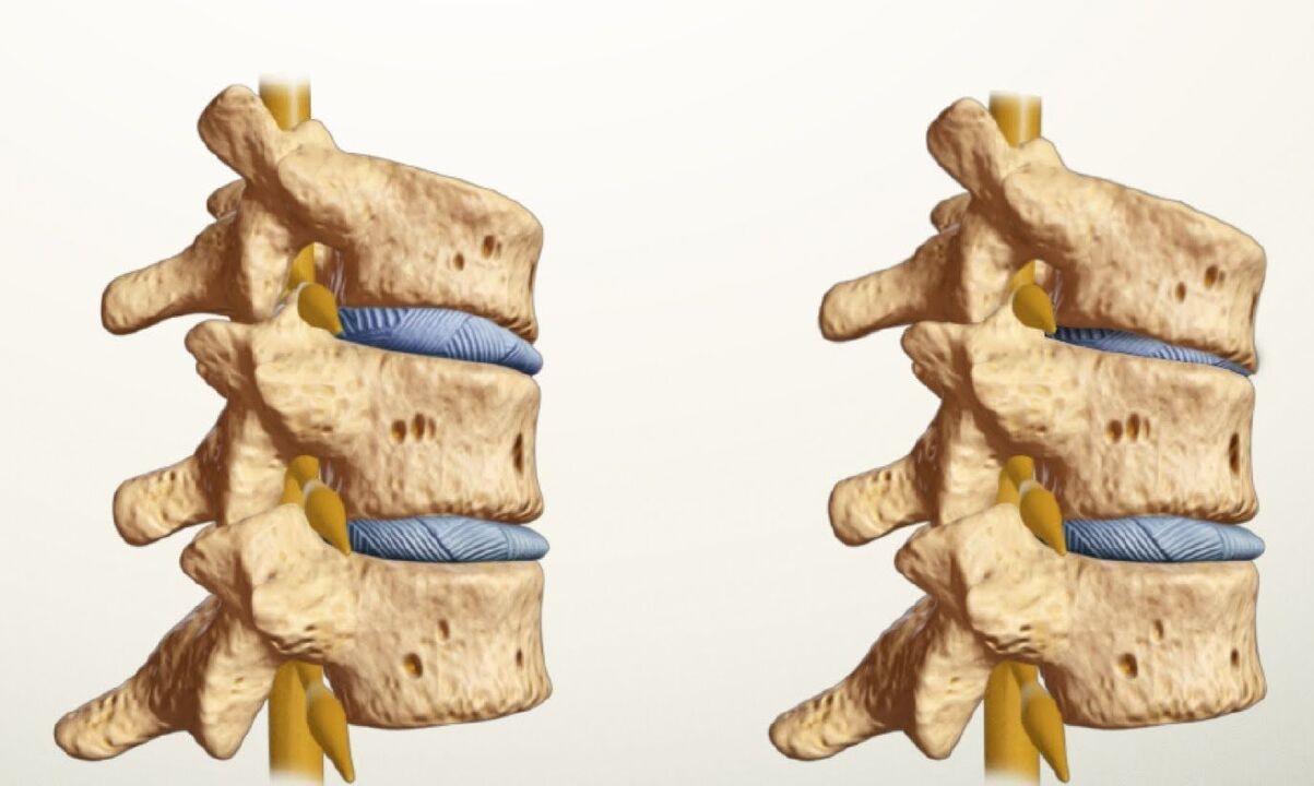healthy and sick spine with lumbar osteonecrosis