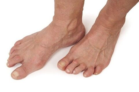 feet affected by dry joints