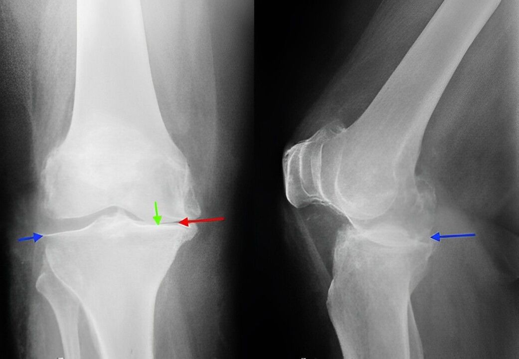 x-ray of knee arthritis