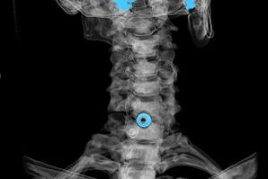Cervical spondylosis on X-ray