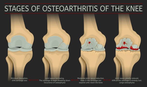 development of arthritis