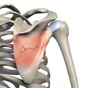 Shoulder blade fracture is one of the causes of severe pain.