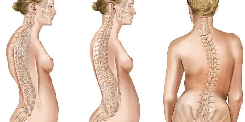 Thoracic scoliosis causes pain in the shoulder blades