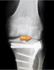 knee arthritis