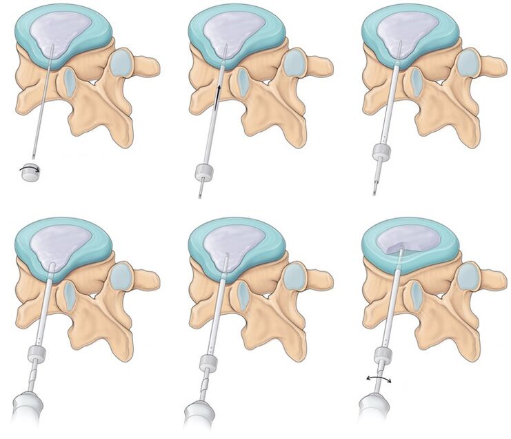 Back pain surgery