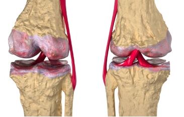Varicose veins are the cause of the development of gonorrhea